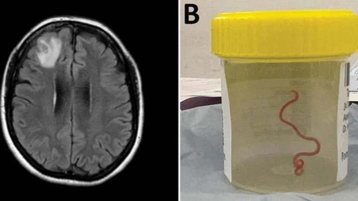 Live worm found in Australian woman's brain in world first